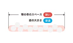 一方、歯がデコボコの場合、顎の大きさよりも歯の大きさが大きく収まりきっていません。