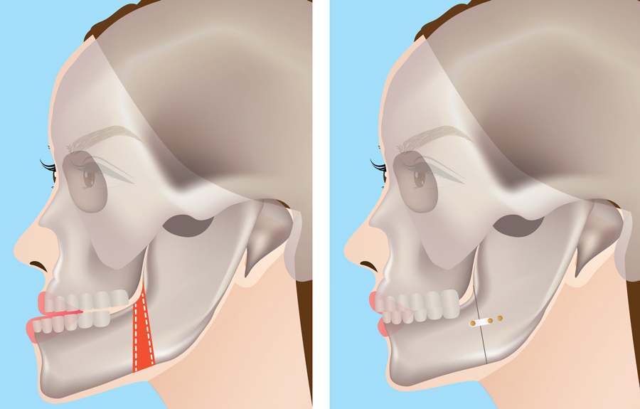 顎の骨を切除する手術と矯正治療の組み合わせ