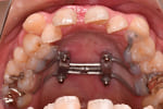 歯列拡大