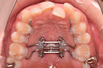 歯列拡大