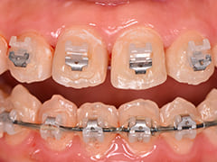 6本の歯を削ることで1歯あたり0.6㎜×6歯＝3.6㎜分大きな歯列を作り出し、歯を抜かずに矯正ができるようになります。