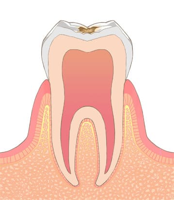 第二度（C1）エナメル質のむし歯C1