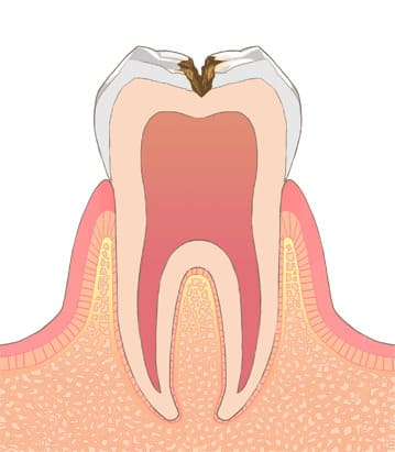 第三度（C2）象牙質のむし歯C2