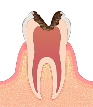 第四度（C3）神経に達したむし歯C3