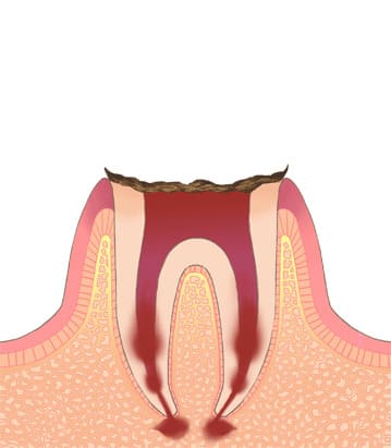 第五度（C4）歯根に達したむし歯C4