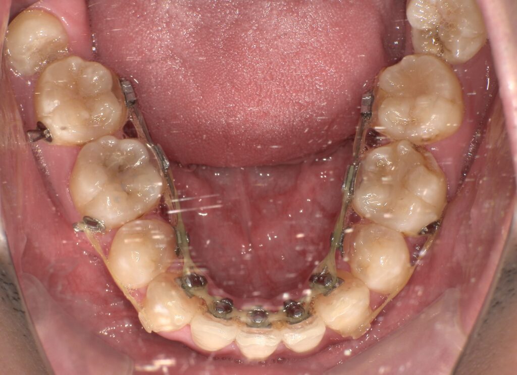 舌側矯正（下顎）