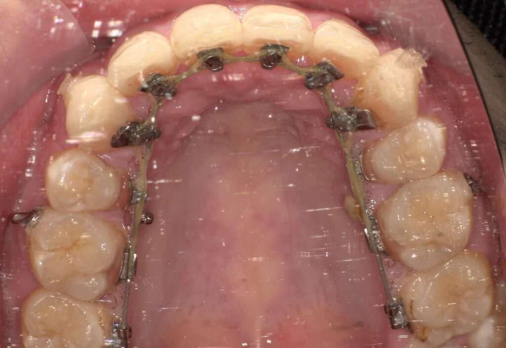 舌側矯正（上顎）