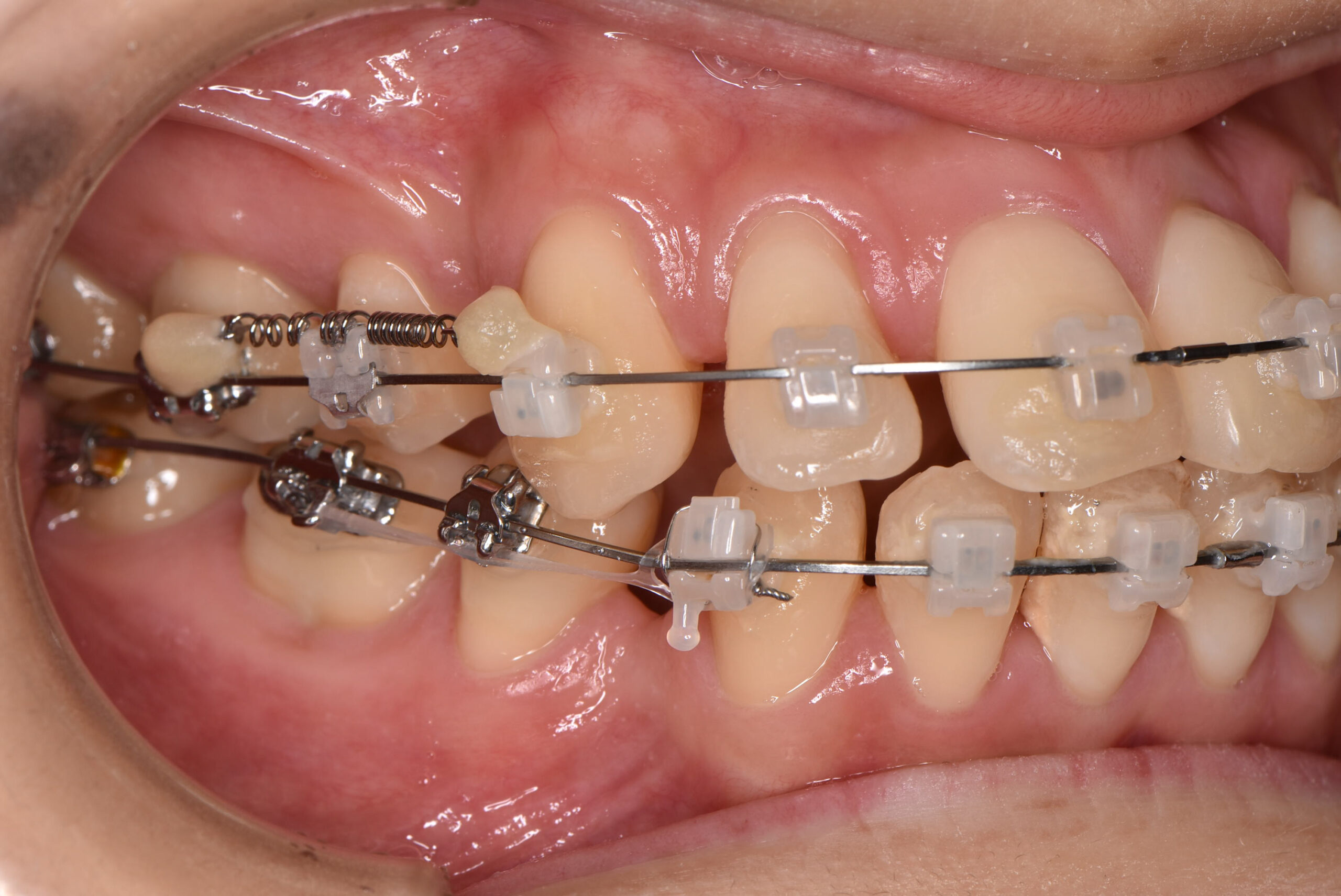 治療の精度と効率を高める「アンカースクリュー」を徹底解説