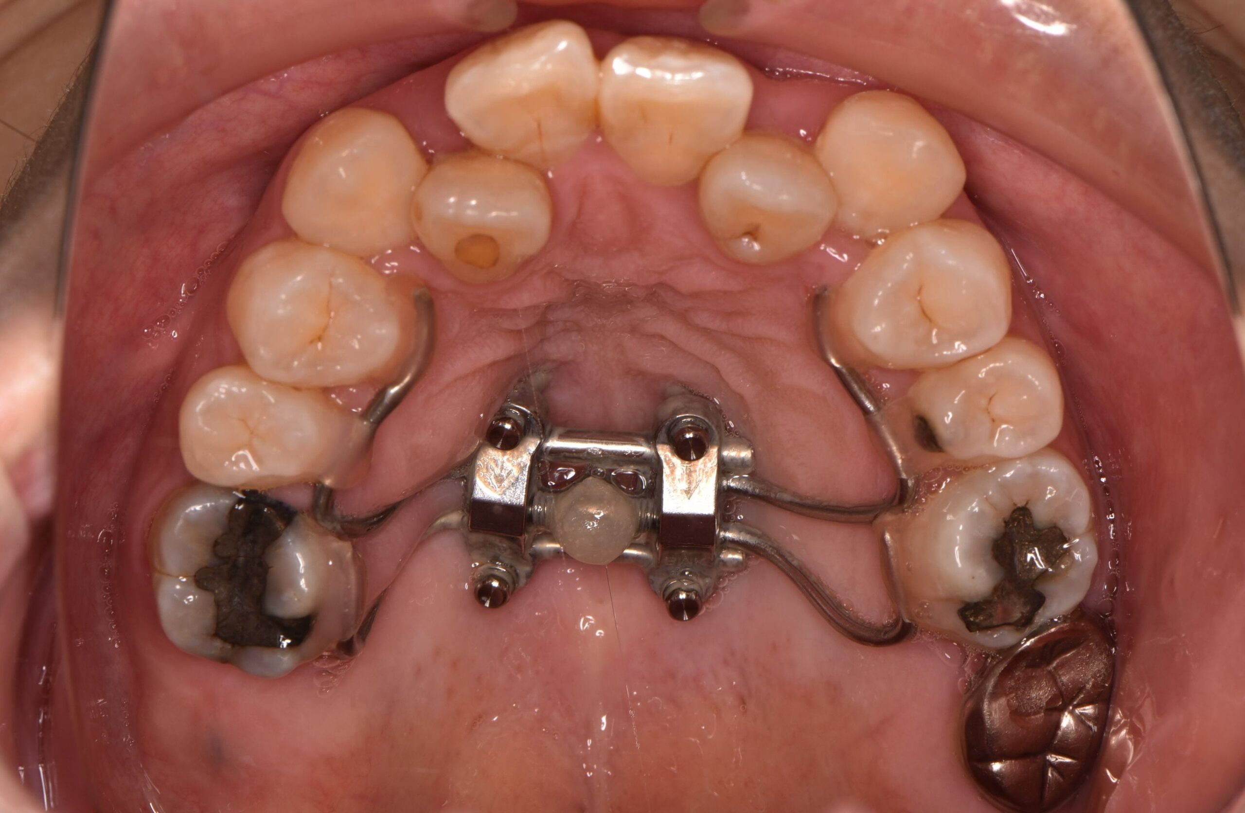 矯正】上あごを広げる魔法の装置【固定式拡大装置】とは？？ | ごとう