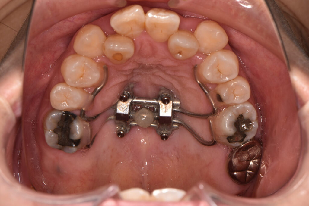 固定式拡大装置