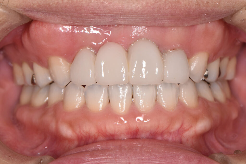 天然の歯が白くなったあとに、被せ物の交換をした状態