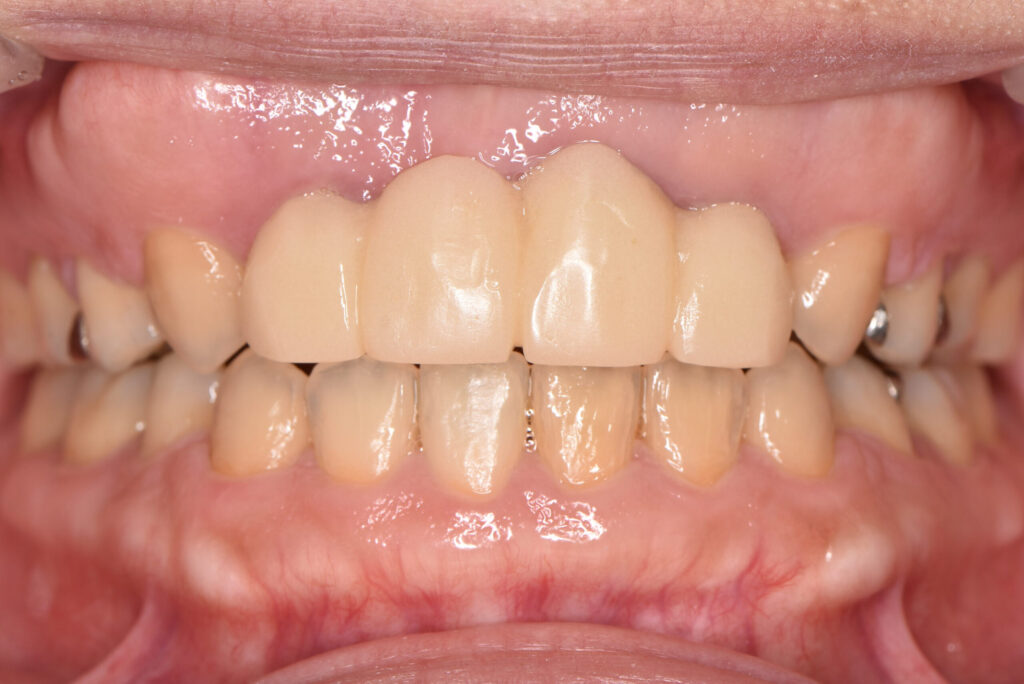 前歯4本に被せ物をしている状態