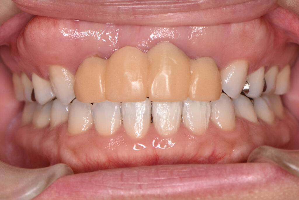 天然の歯を白くした状態