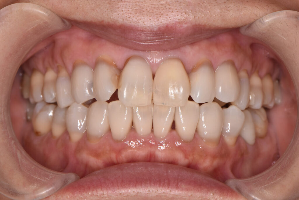 テトラサイクリン歯