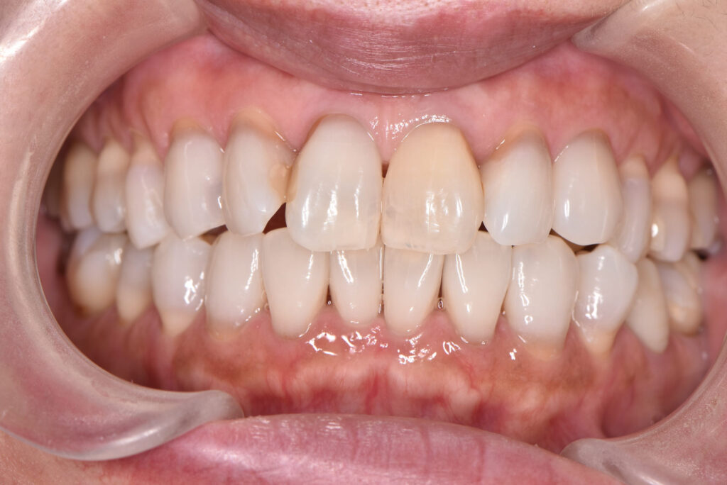 テトラサイクリン歯（施術後）