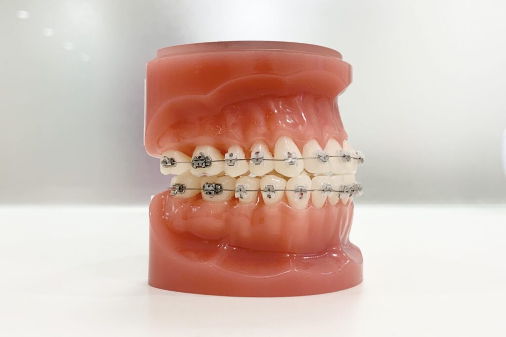 矯正中の歯科模型