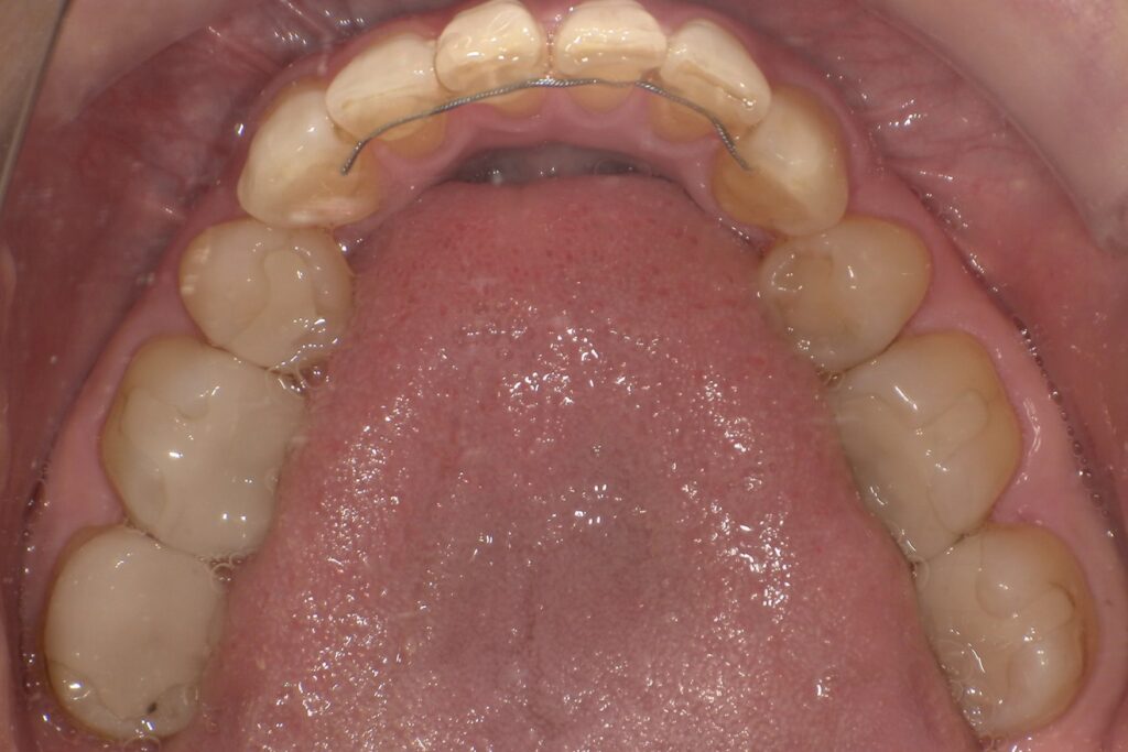 固定式リテーナー