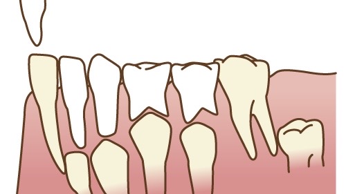 乳歯の生え変わり