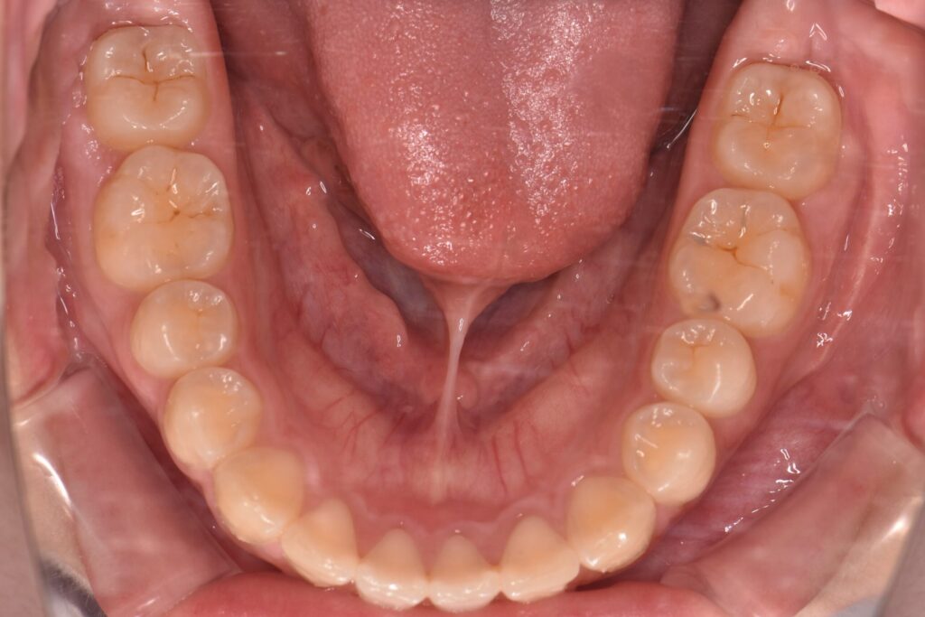 矯正終了直後の歯並び