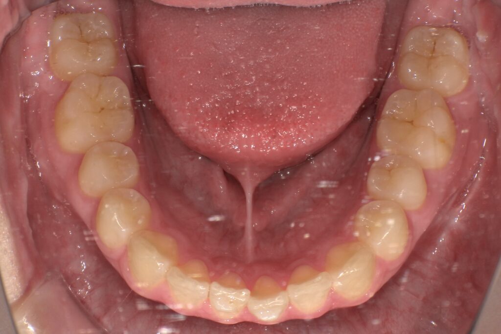 後戻りを始めた歯並び