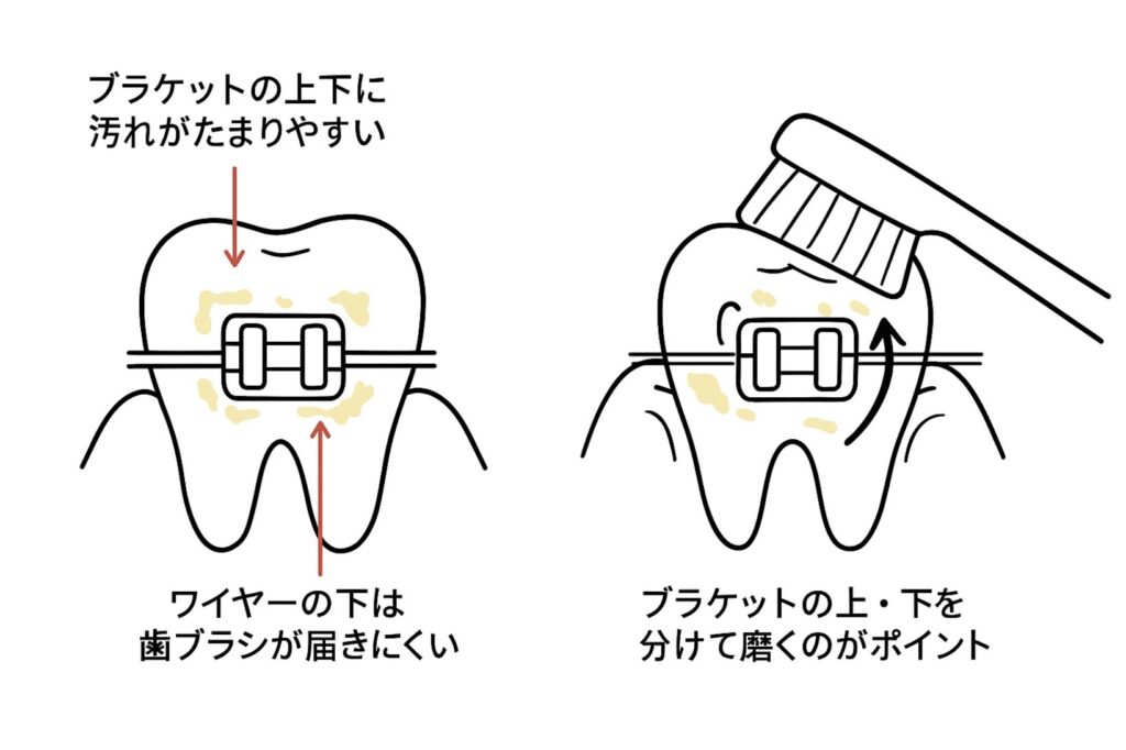 矯正中のブラッシングのコツ