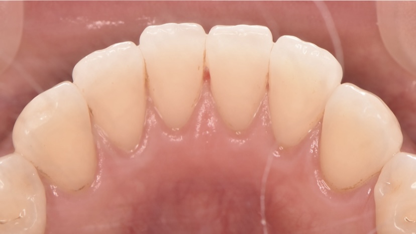 エアーフロー（施術後）