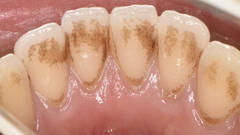 エアーフロー（施術前）