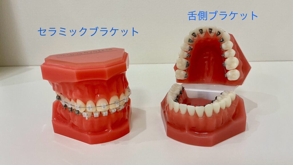 セラミックブラケットと舌側ブラケット