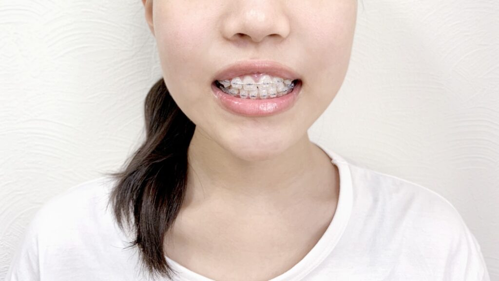 矯正中の口元