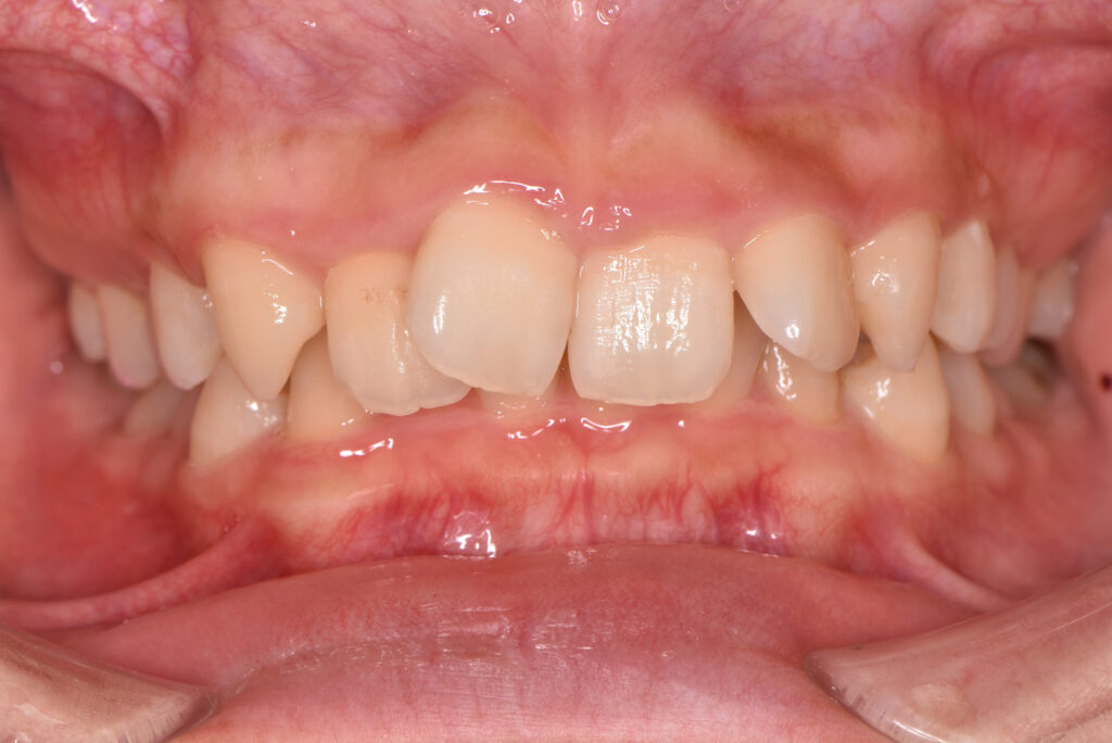 過蓋咬合：上の歯が下の歯を覆い