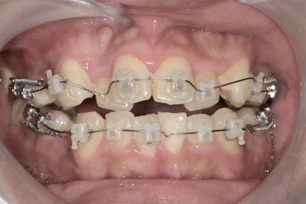 当院で使用しているセラミックブラケットの写真（山形市の矯正歯科）