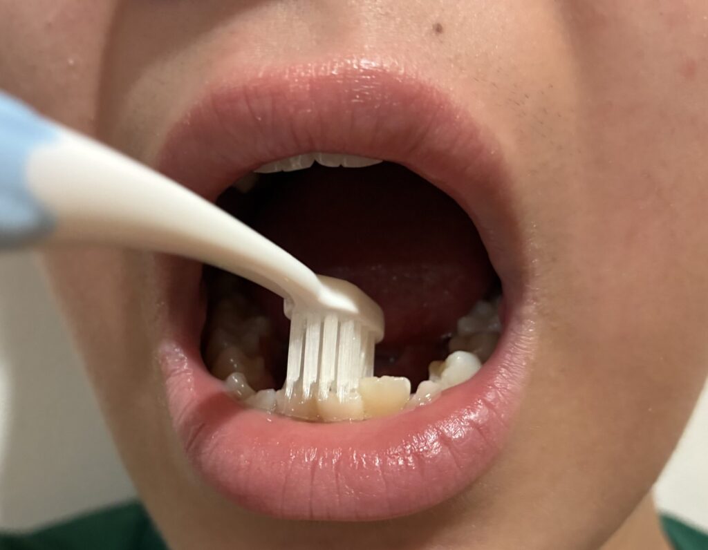 下の前歯の内側