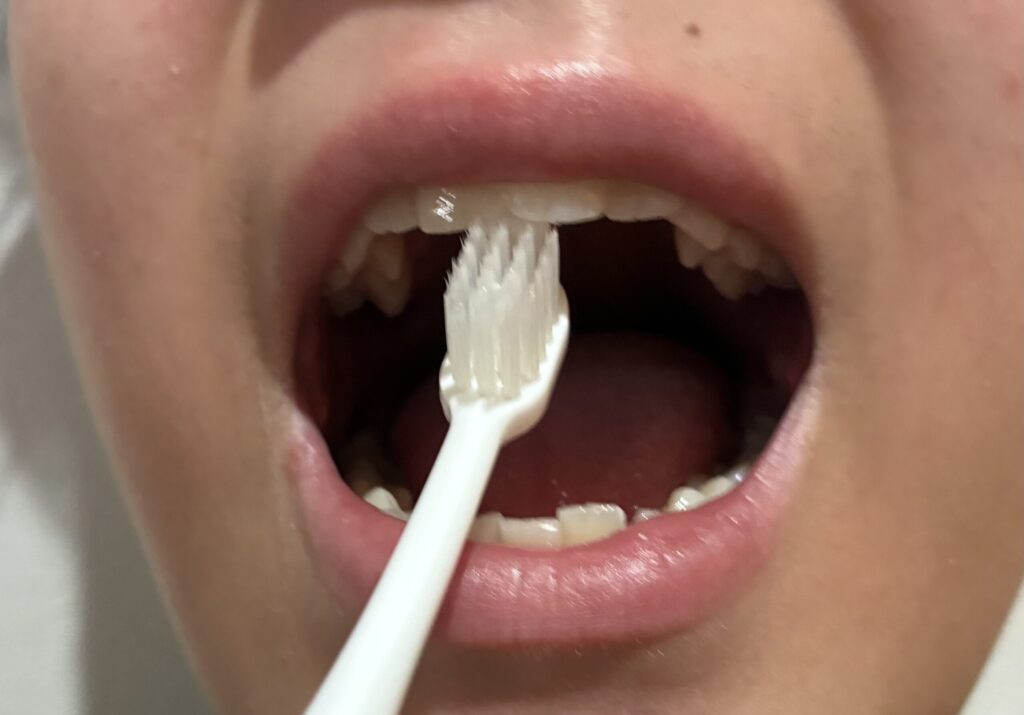 上の前歯の内側