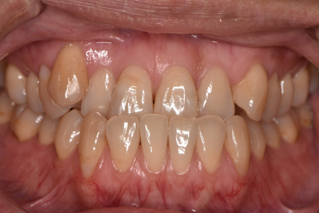 受け口（下顎前突）：下の歯が前に出る