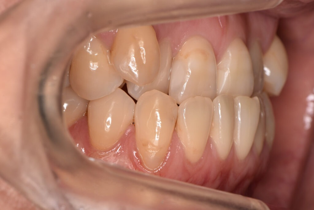 受け口（下顎前突）：下の歯が前に出る