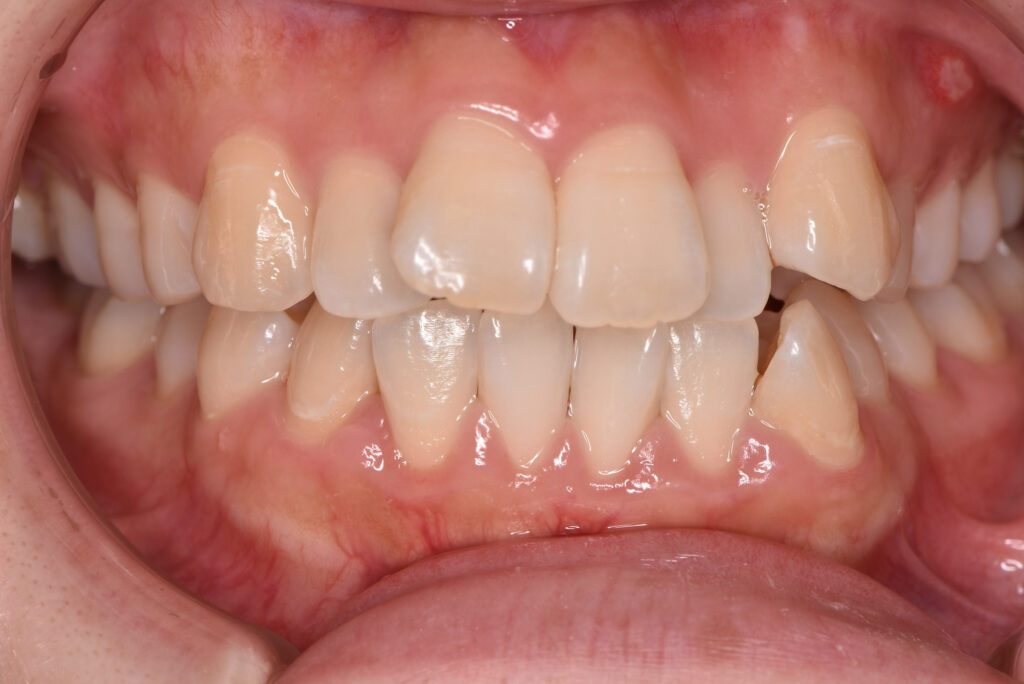 出っ歯（上顎前突）：上の歯が前に突き出る