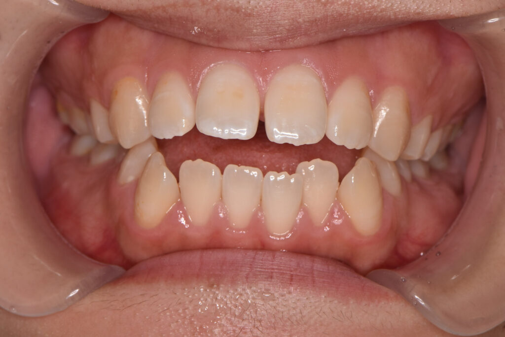 開咬：噛んでも前歯が閉じない