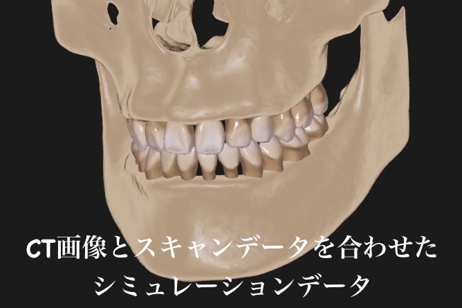CT画像とスキャンデータを合わせたシミュレーションデータ