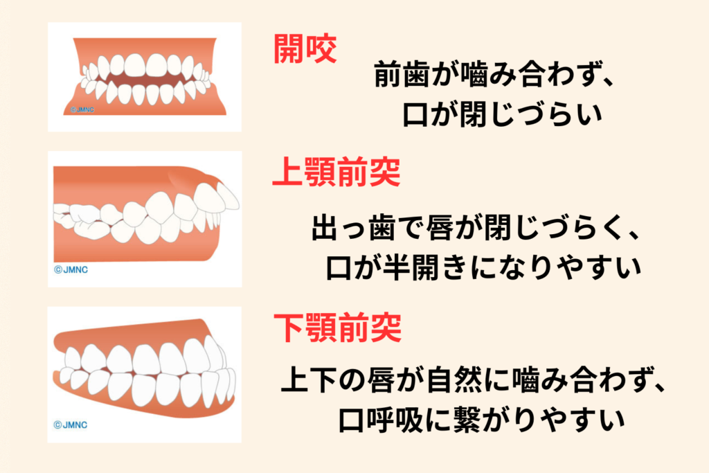 口が閉じにくい歯並び