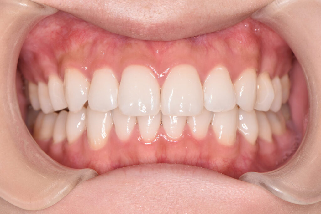 ホワイトニング（施術後）