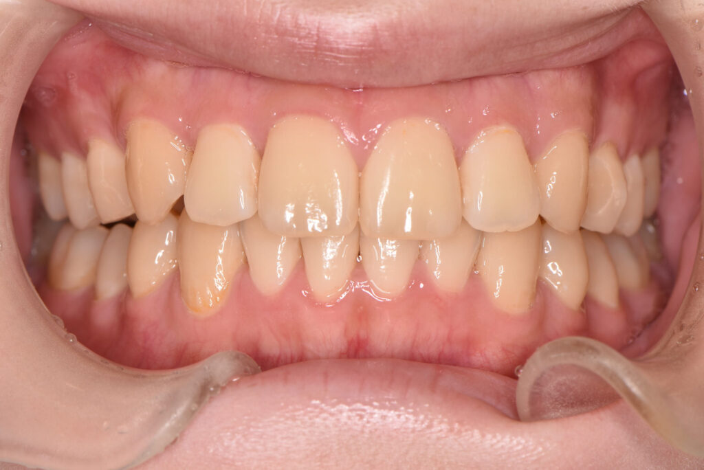 ホワイトニング（施術前）