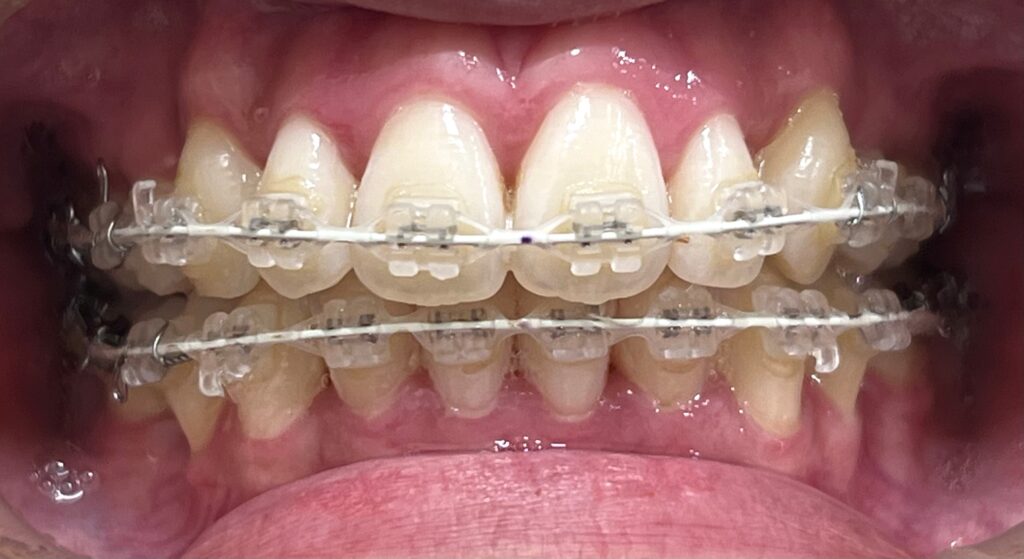 ブラケット矯正中のホワイトニング（アフター）
