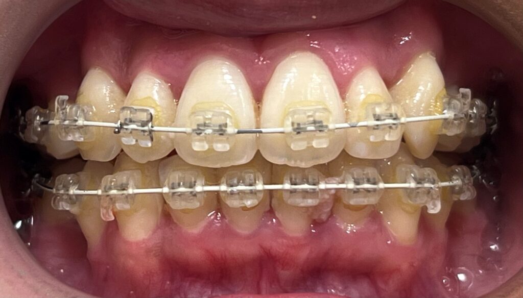 ブラケット矯正中のホワイトニング（ビフォー）