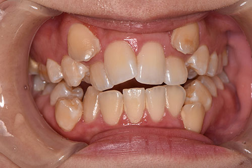 叢生（そうせい）：歯が重なり合うガタガタの状態