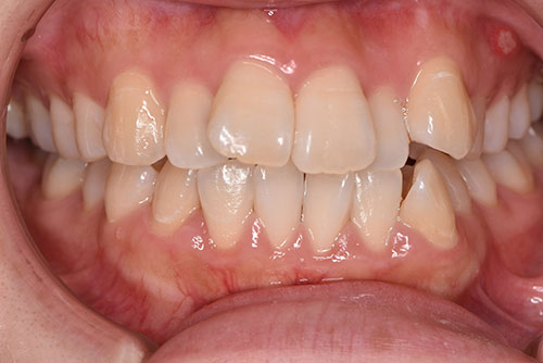 出っ歯（上顎前突）：上の歯が前に突き出る