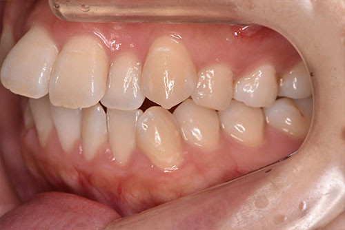 出っ歯（上顎前突）：上の歯が前に突き出る