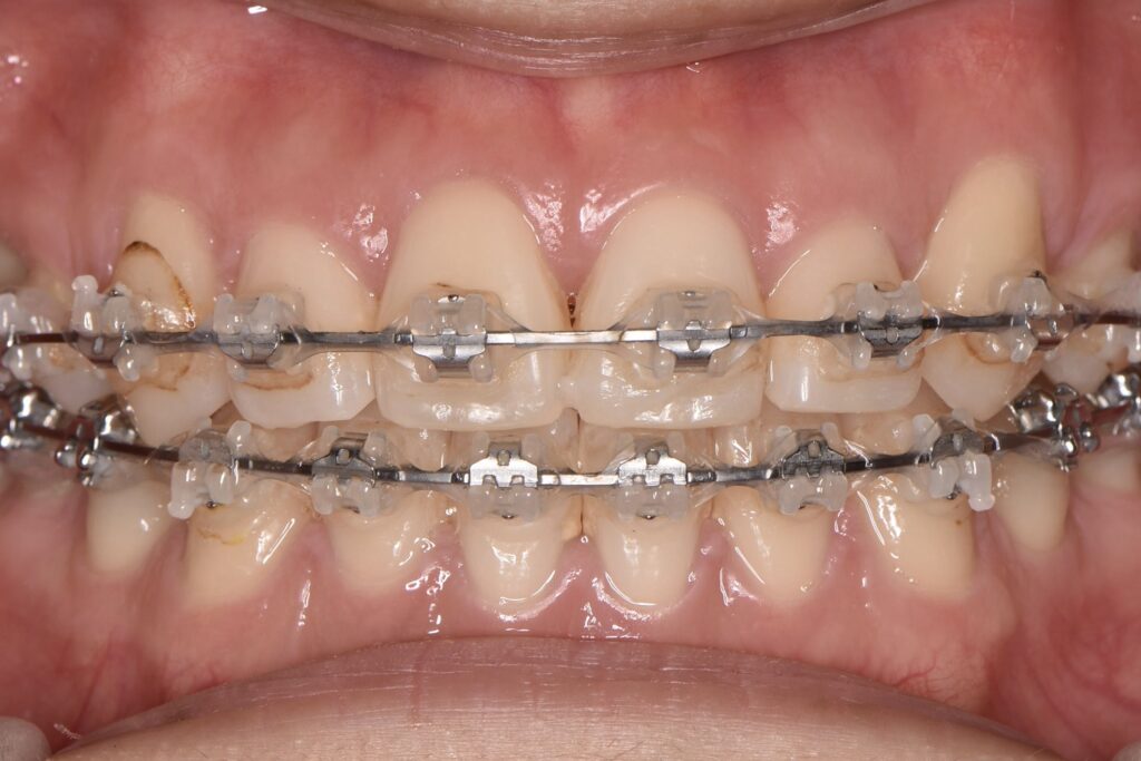 表側マルチブラケット矯正(治療中・後半)