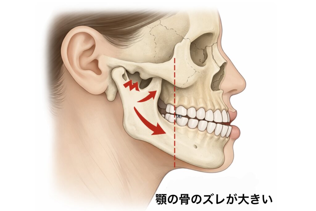 顎の骨のずれが大きい状態を横顔で示した説明用イラスト