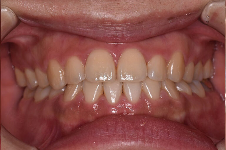 矯正治療により反対咬合が改善した口元を、正面から撮影した写真