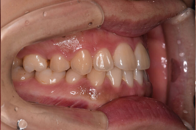 矯正治療により反対咬合が改善した口元を、左側から撮影した写真